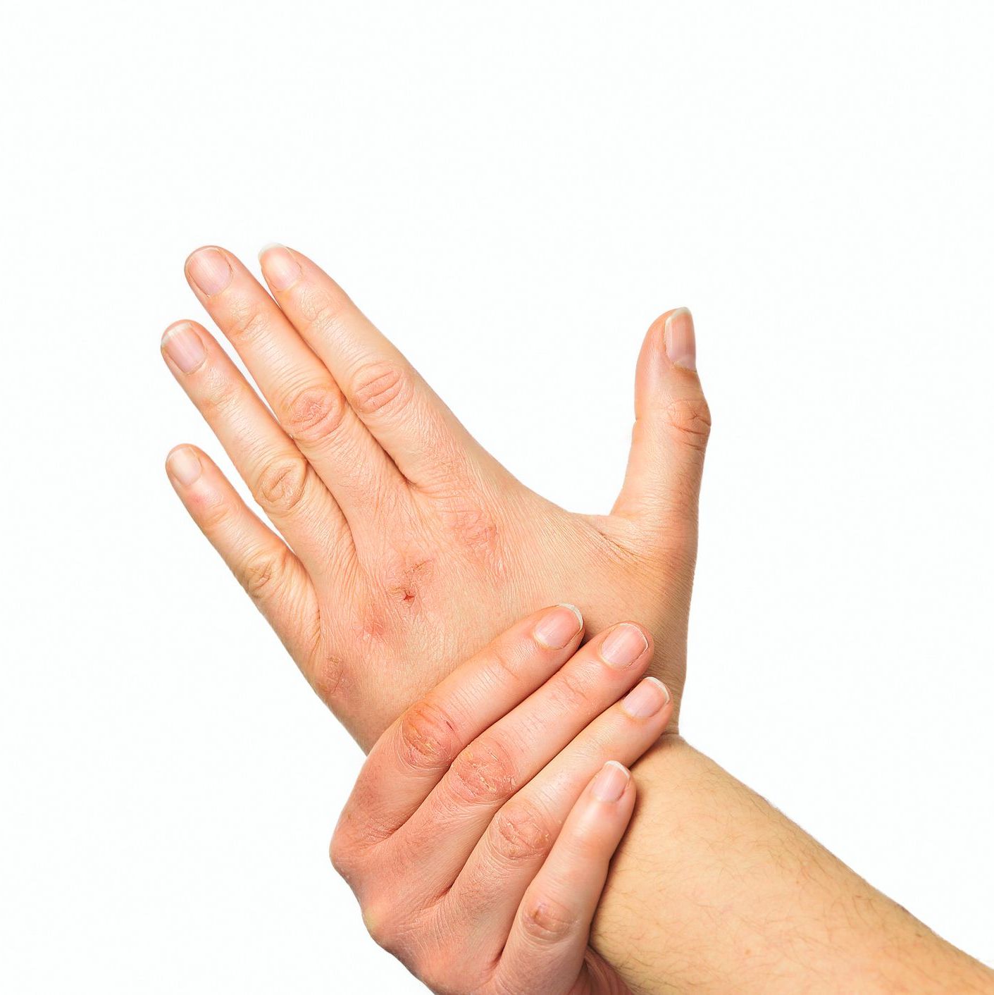 What Causes Dry Hands? 7 Common Reasons & How to Prevent Them